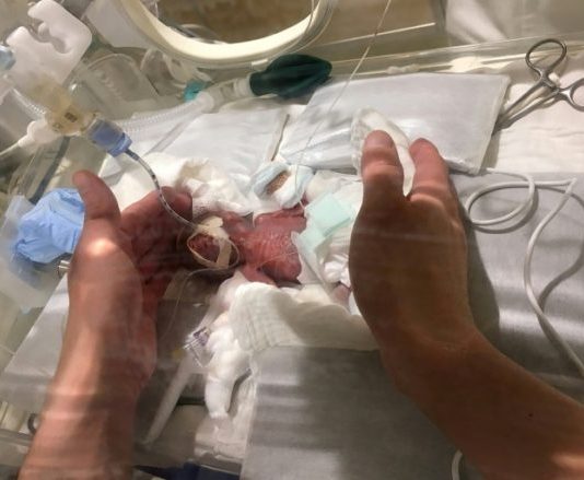 Bebé que nació pesando 268 gramos, deja el hospital sano y salvo