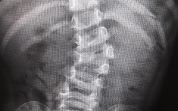 Médicos del IMSS corrigen severa malformación en la columna de una niña de 4 años