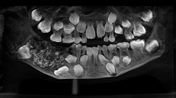 Fue al médico por un dolor maxilar y le extraen más de 500 dientes