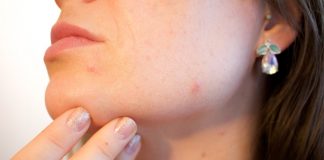 El acné es el problema dermatológico más frecuente entre los adolescentes