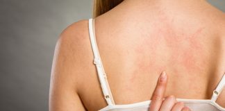 La psoriasis es una enfermedad grave de la piel, pero no es contagiosa