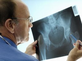Mujeres mayores de 50 y hombres de más de 60, principales afectados por la osteoporosis