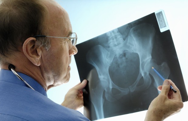 Mujeres mayores de 50 y hombres de más de 60, principales afectados por la osteoporosis