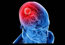 Los tumores cerebrales son más frecuentes en hombres que en mujeres