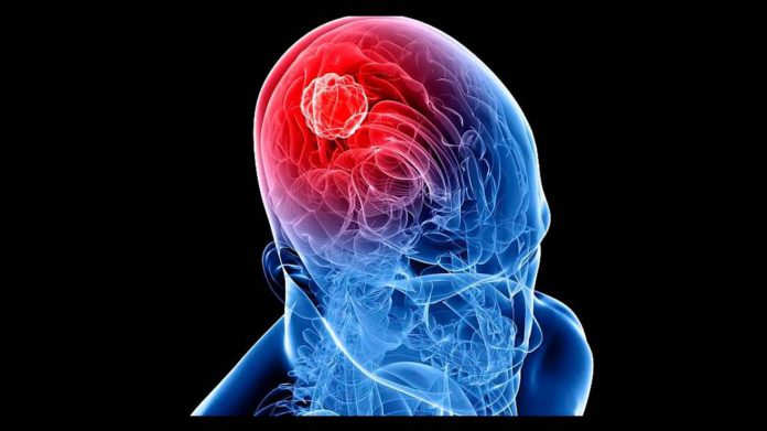 Los tumores cerebrales son más frecuentes en hombres que en mujeres