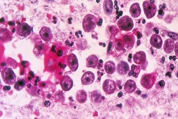 Florida emite alerta por infección de ameba 
