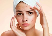 Reduce las molestias del acné con ingredientes que tienes en casa