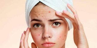 Reduce las molestias del acné con ingredientes que tienes en casa