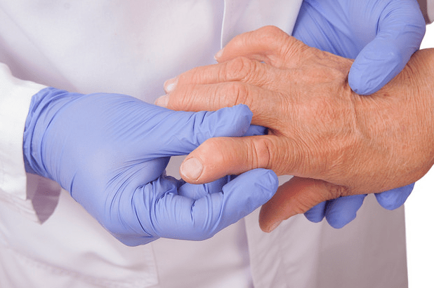 Tratamiento para artritis podría funcionar para Covid-19