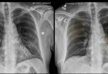 Trasplante de pulmón podría salvar a pacientes con Covid-19