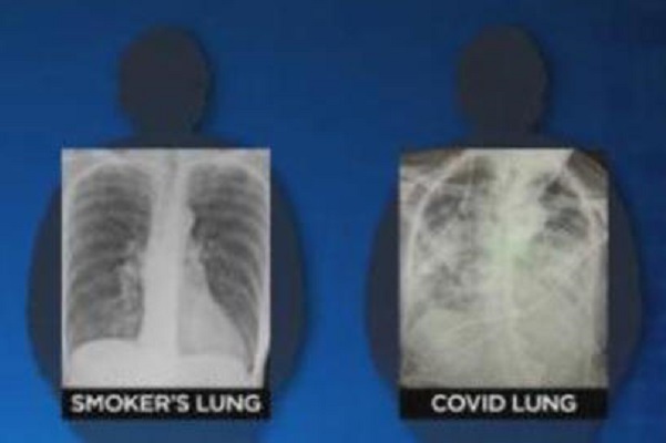 Covid-19, incluso en asintomáticos, daña los pulmones como si fumaras toda una vida