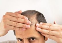 El estrés y la alopecia están relacionados