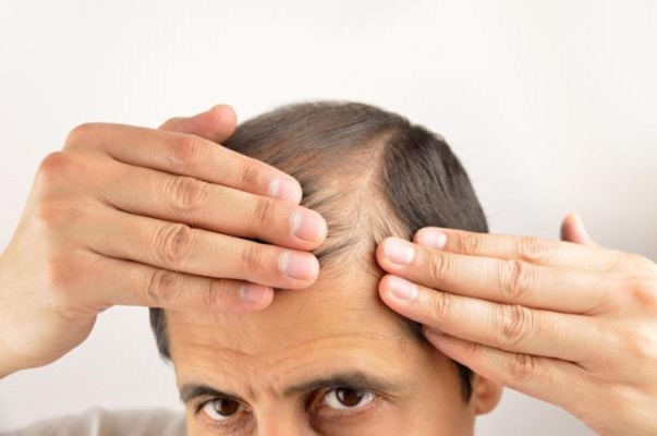 El estrés y la alopecia están relacionados