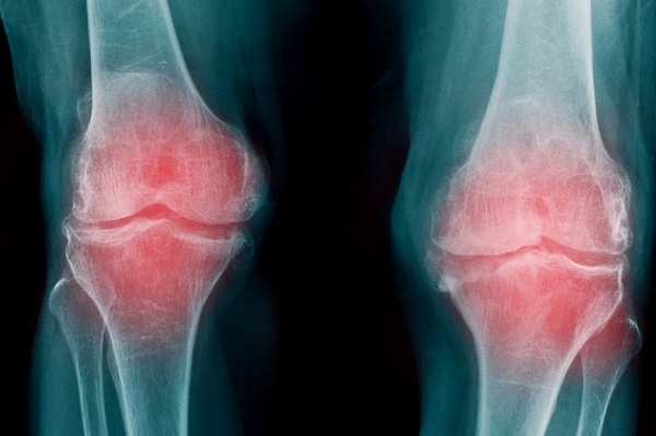 Te contamos qué es la artrosis y cómo prevenirla