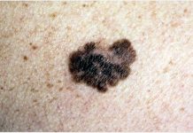Encuentran que los pacientes con Parkinson son más susceptibles al melanoma
