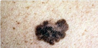 Encuentran que los pacientes con Parkinson son más susceptibles al melanoma