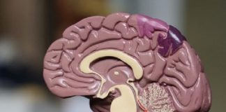 Cerebros de fallecidos por COVID-19 muestran deterioro similar al Alzheimer