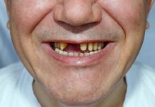 Una pérdida de dientes se asocia a un mayor deterioro cognitivo