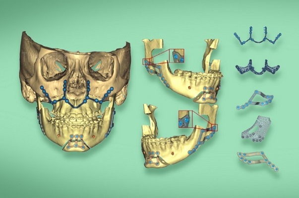La reconstrucción mandibular en 3D, un paso a la medicina del futuro