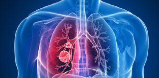 COVID-19 podría elevar casos de cáncer de pulmón