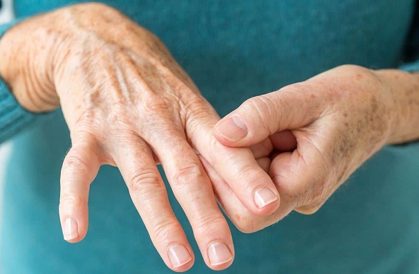 Principalmente, las manos se deforman por artritis y artrosis