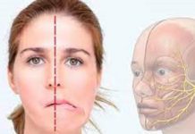 Qué es la parálisis facial, qué puede causarla y cómo detectarla