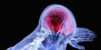 Derrame cerebral: qué lo provoca y cuáles son los síntomas