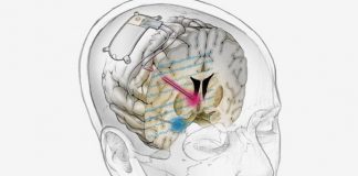 Dispositivo cerebral trata con éxito a paciente con depresión grave
