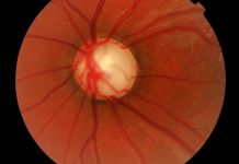 El glaucoma, la enfermedad que provoca la pérdida de la visión
