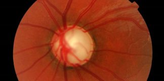 El glaucoma, la enfermedad que provoca la pérdida de la visión