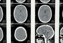 Implante cerebral permite a paciente paralizado comunicarse