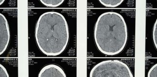 Implante cerebral permite a paciente paralizado comunicarse